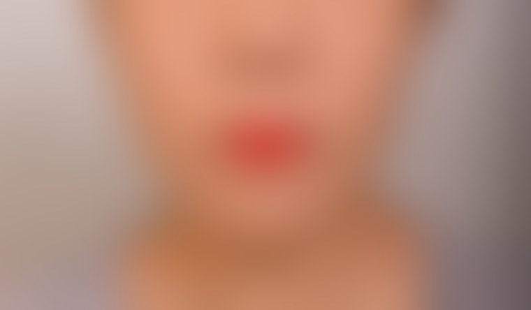 실리프팅 사례 1 시술 후 정면