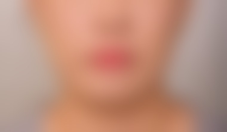 실리프팅 사례 2 시술 후 정면